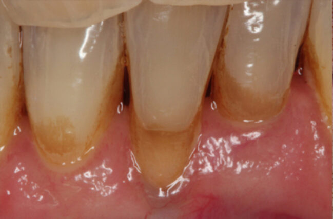 Before - Periodental